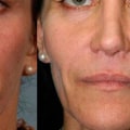 Can Cheek Fillers Help Reduce Wrinkles Under the Eyes?