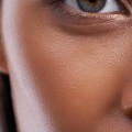 Do Cheek Fillers Worsen Wrinkles Under the Eyes?