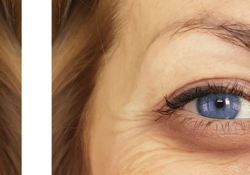 How Long Does It Take for Filler to Settle Under the Eyes?