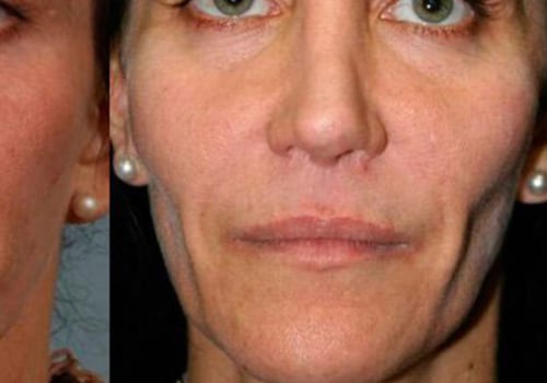 Can Cheek Fillers Help Reduce Wrinkles Under the Eyes?