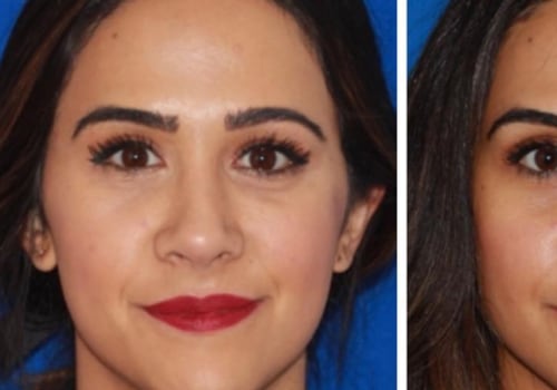 What Happens to Fillers Under the Eyes Over Time?